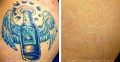 Eraser Clinic Laser Tattoo Removal